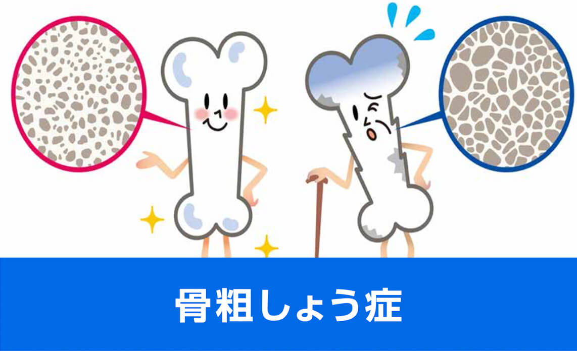 骨粗しょう症